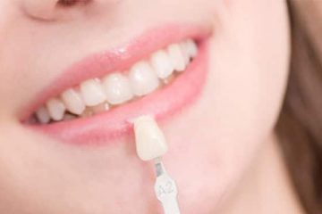How Much Do Porcelain Veneers Cost