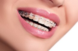 orthodontics dental treatment in houston